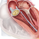 Illustration of robotic catheter navigation to the site of the leaking prosthetic valve.